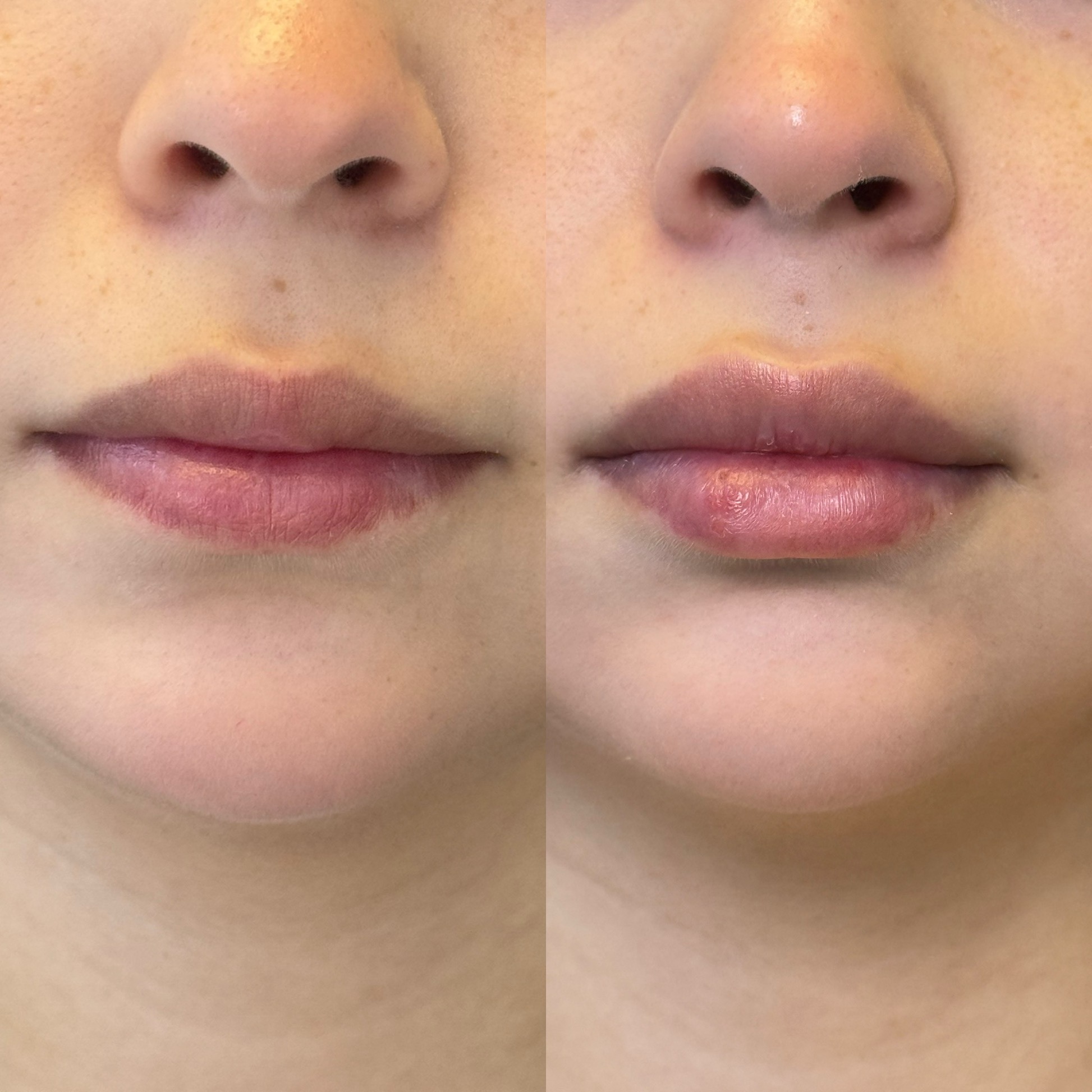 Labios con acido hialurónico