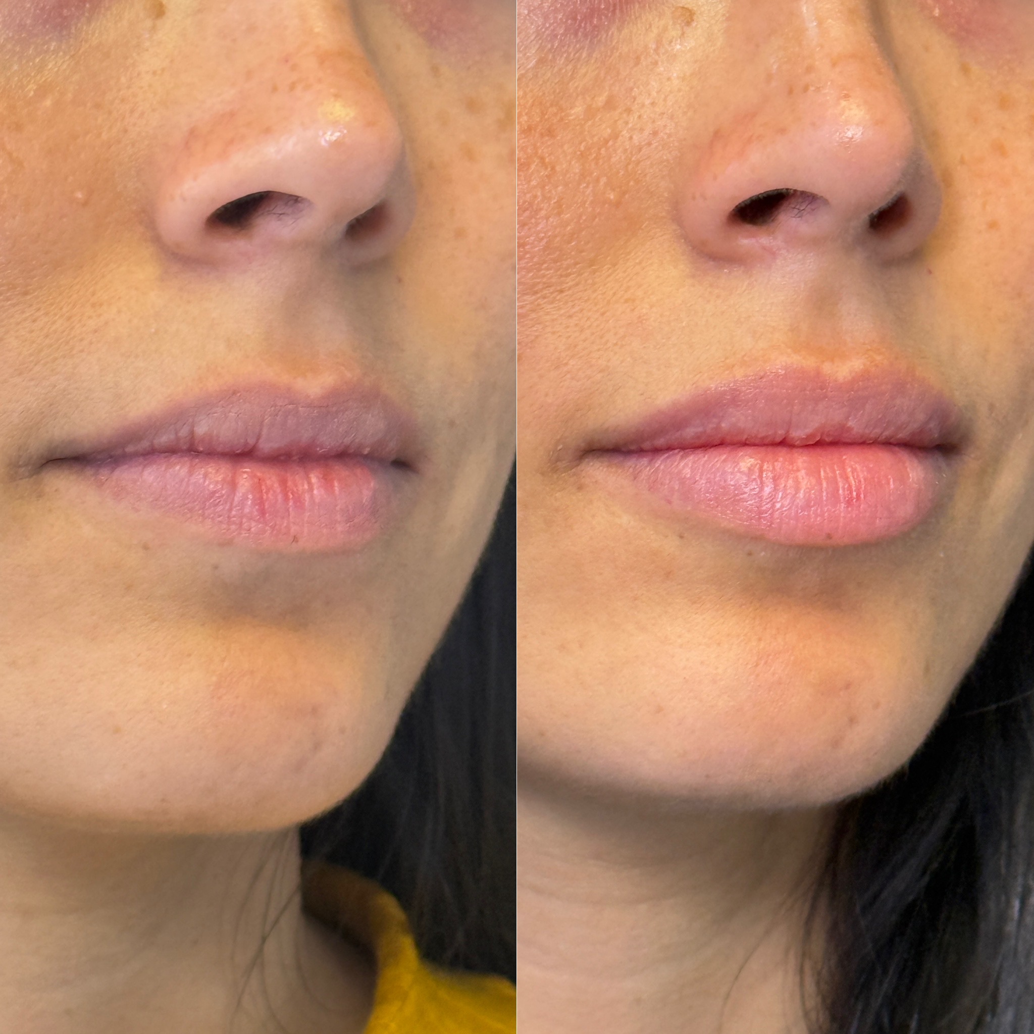 Labios con acido hialurónico