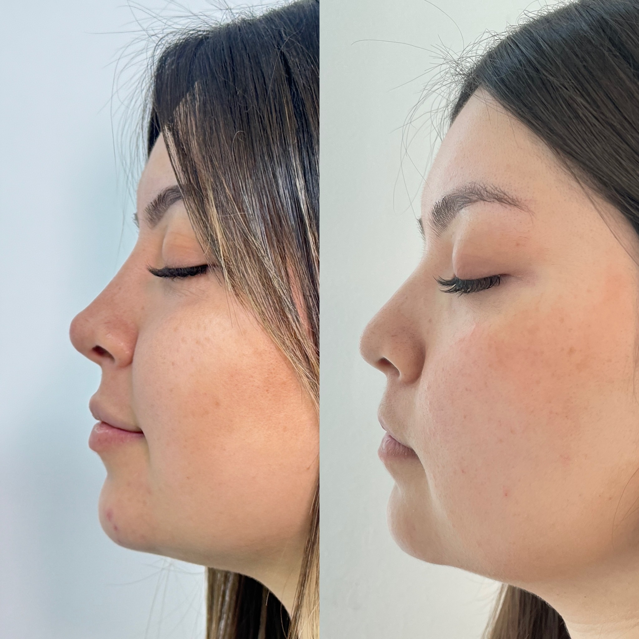 Rinolips (Rinomodelación + labios con acido hialurónico)